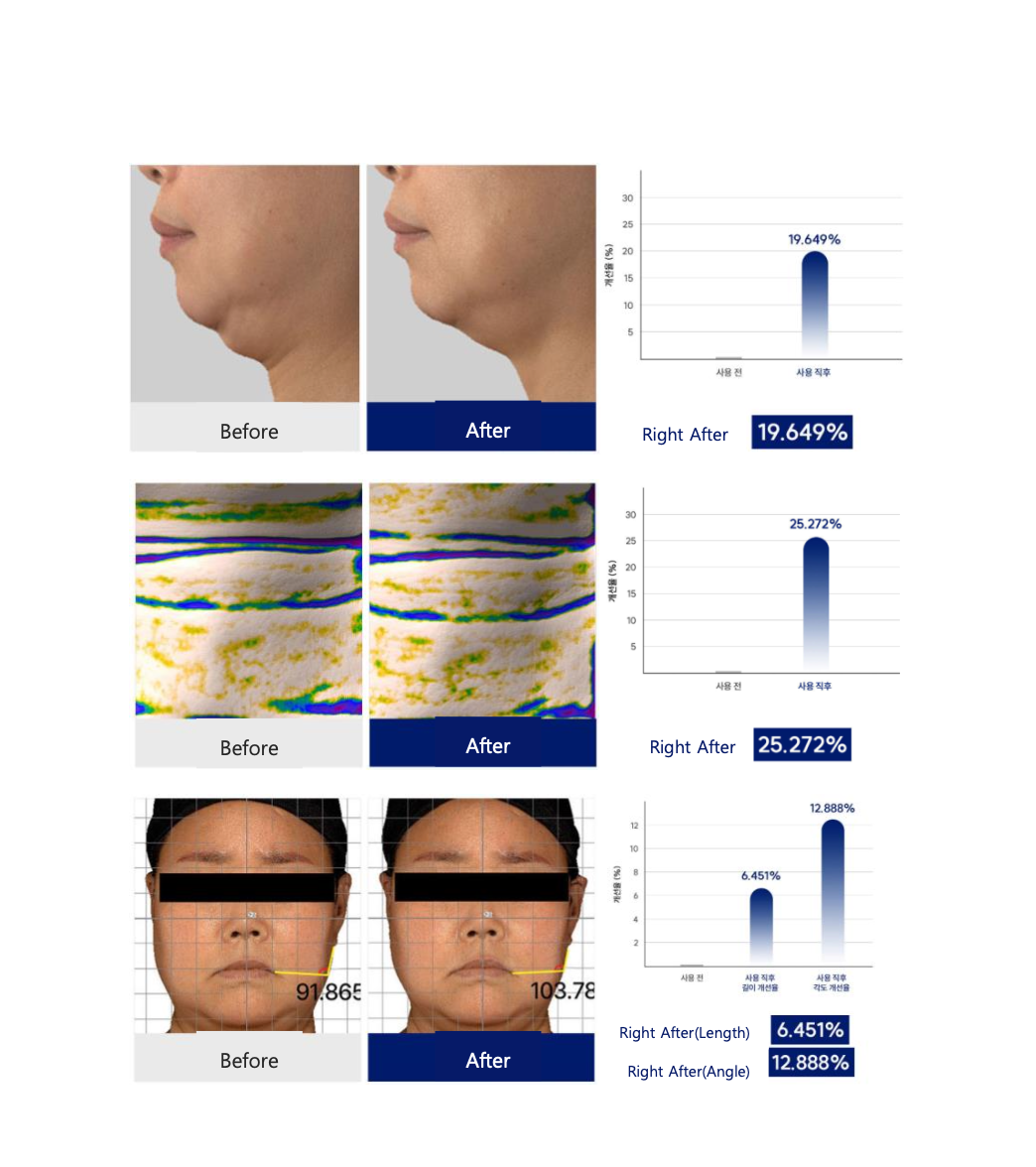 ID PLACOSMETIC Face Fit Minus Band V3 pleistras žandikaulio linijai - Image 3